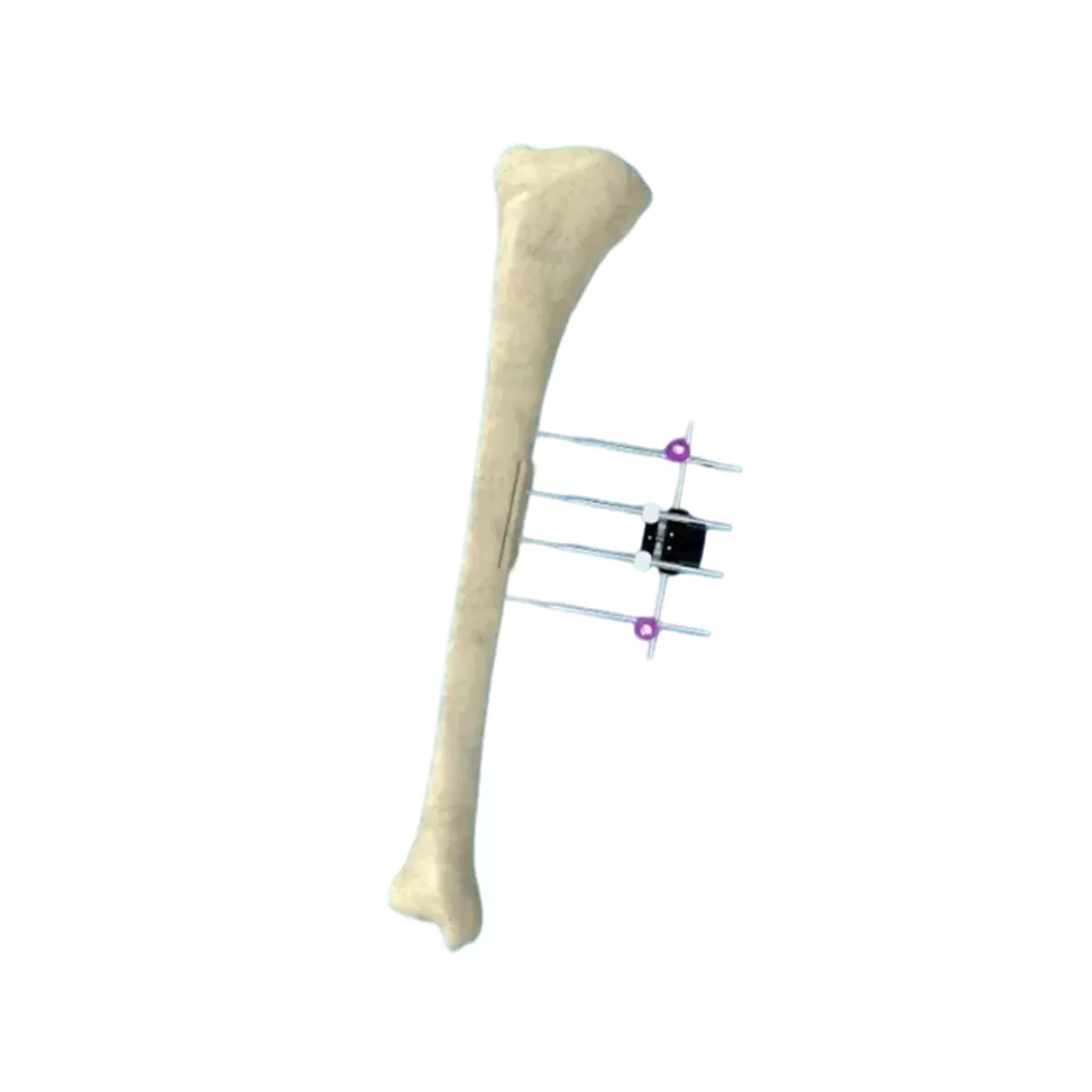 Transverse Bone Transport External Fixator