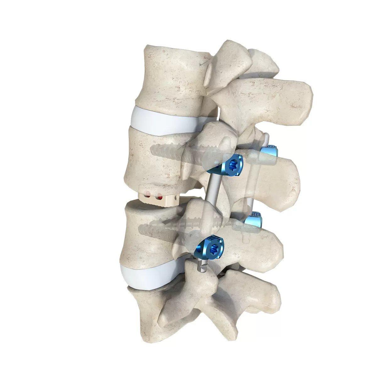 Lumbar Interbody Fusion Cage LF-II