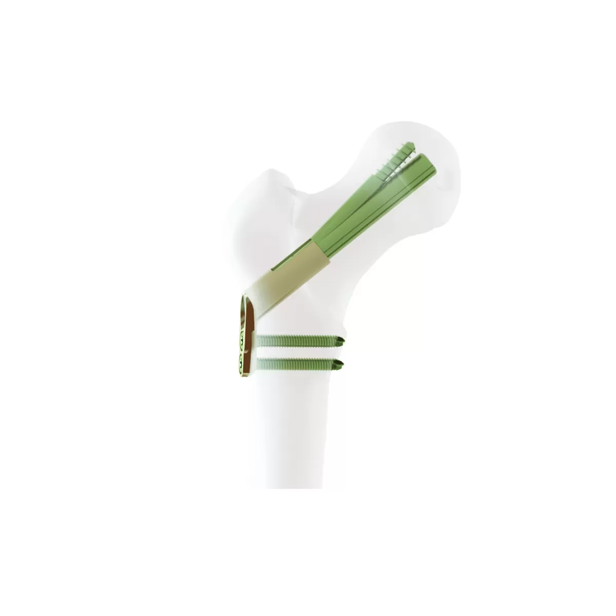 Femoral Neck System-FNS