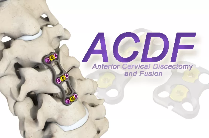 Anterior Cervical Discectomy and Fusion (ACDF) – The Importance of ACDF Plates in Today's Cervical Spine Surgery