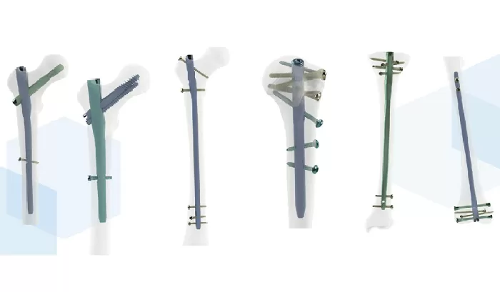 Orthopedic Implant -- Intramedllary Nail