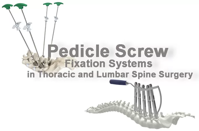 Pedicle Screw Fixation Systems in Thoracic and Lumbar Spine Surgery