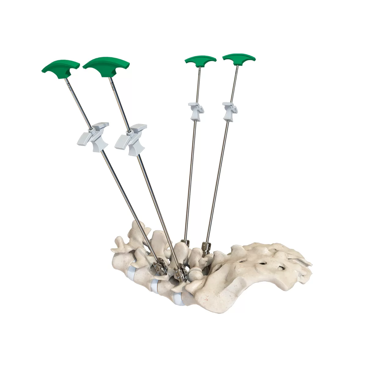 Bone Cement Conveyor System