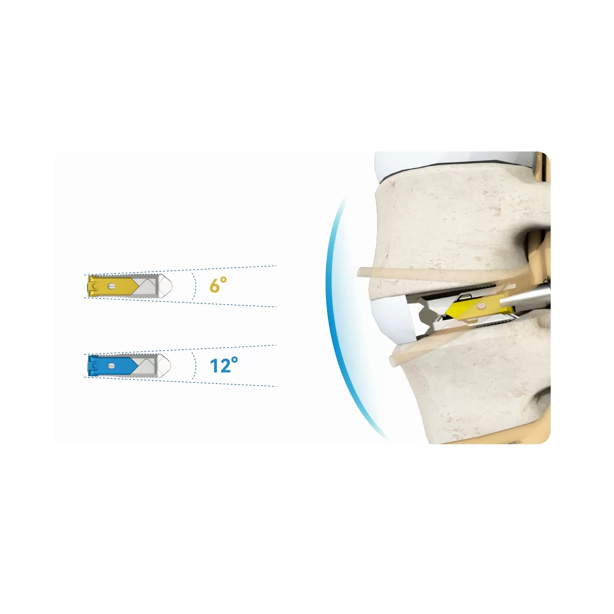 Expandable Interbodyfusion Cage