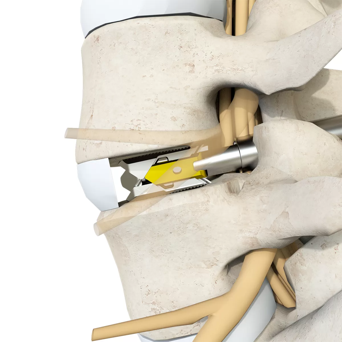 Expandable Interbodyfusion Cage