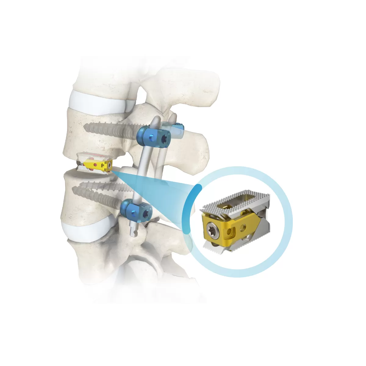 Expandable Interbodyfusion Cage