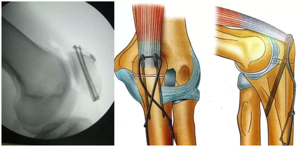 Kirschner Wire in Orthopedic Surgery