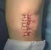 Suture Anchor Fixation for Inferior Pole Patellar Fractures
