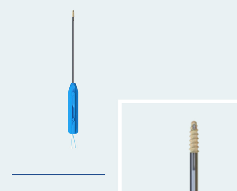 Suture Anchor Fixation for Inferior Pole Patellar Fractures