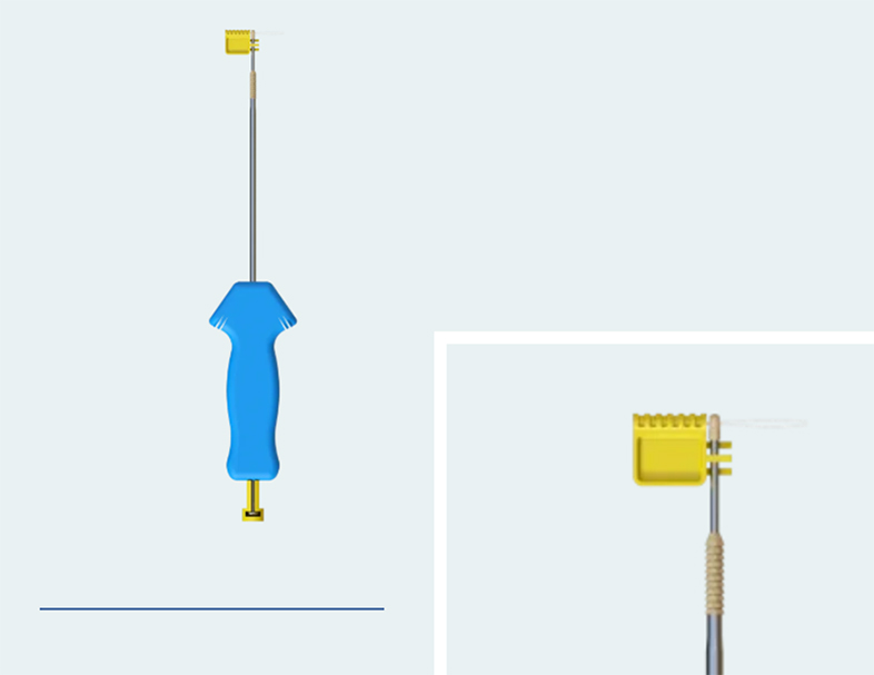 Suture Anchor Fixation for Inferior Pole Patellar Fractures