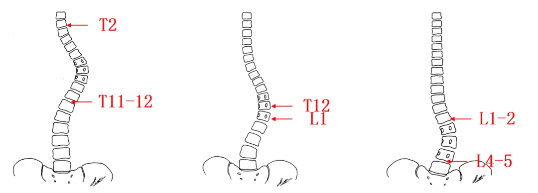 PUMC Classification and Solutions for Idiopathic Scoliosis