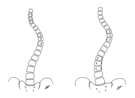 PUMC Classification and Solutions for Idiopathic Scoliosis