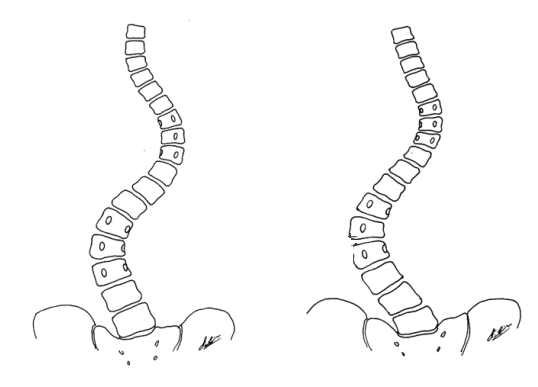 PUMC Classification and Solutions for Idiopathic Scoliosis