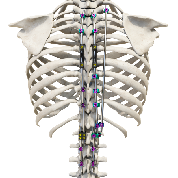 PUMC Classification and Solutions for Idiopathic Scoliosis