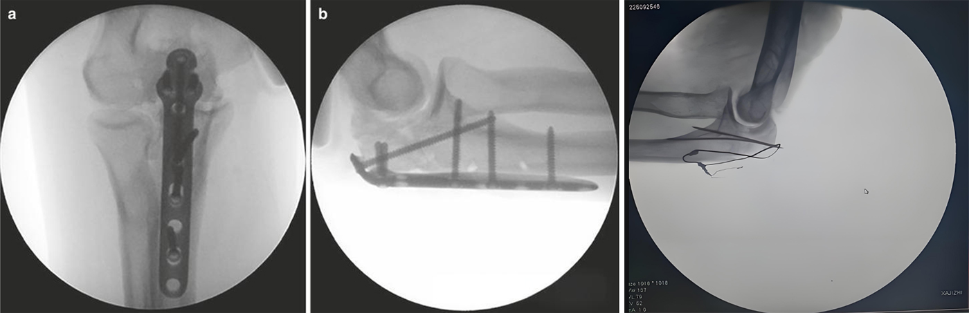 Internal Fixation Techniques for Olecranon Fractures of the Ulna