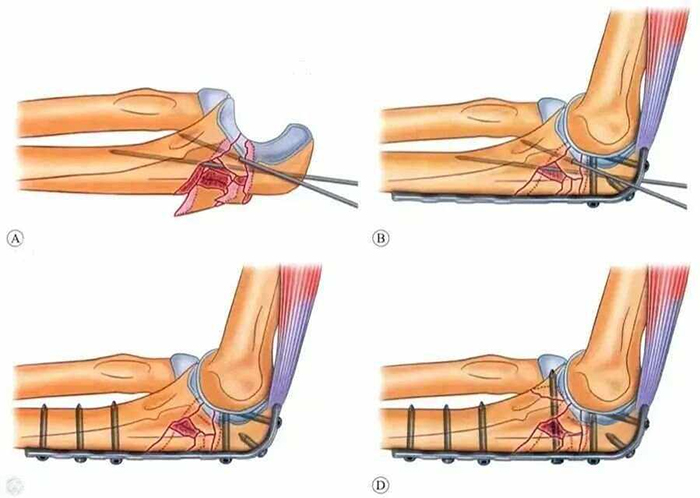 Internal Fixation Techniques for Olecranon Fractures of the Ulna