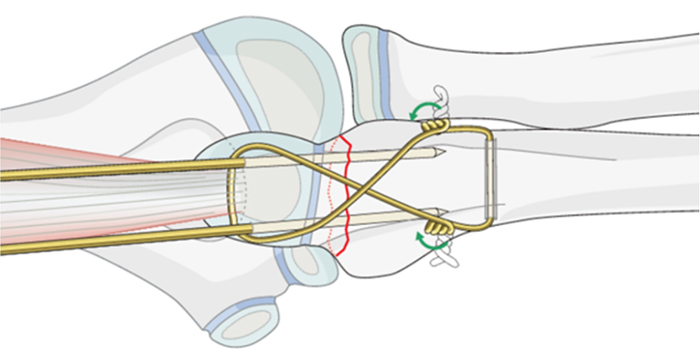 Internal Fixation Techniques for Olecranon Fractures of the Ulna
