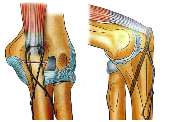 Internal Fixation Techniques for Olecranon Fractures of the Ulna