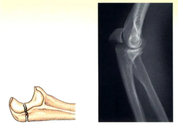 Internal Fixation Techniques for Olecranon Fractures of the Ulna