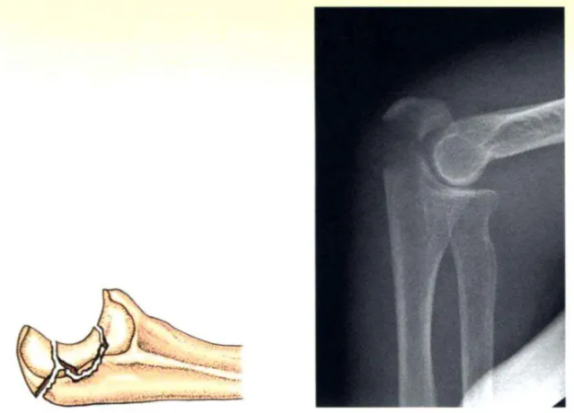 Internal Fixation Techniques for Olecranon Fractures of the Ulna