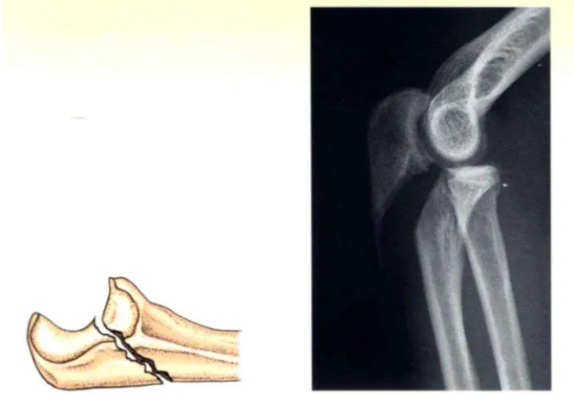Internal Fixation Techniques for Olecranon Fractures of the Ulna