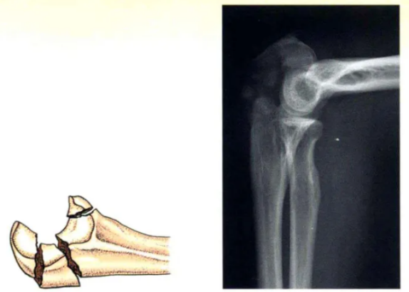 Internal Fixation Techniques for Olecranon Fractures of the Ulna