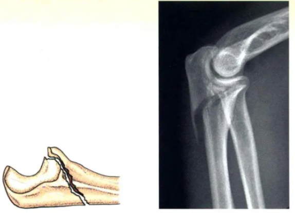 Internal Fixation Techniques for Olecranon Fractures of the Ulna