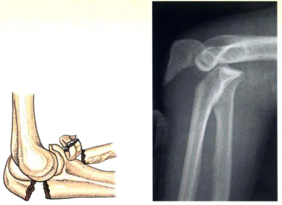 Internal Fixation Techniques for Olecranon Fractures of the Ulna