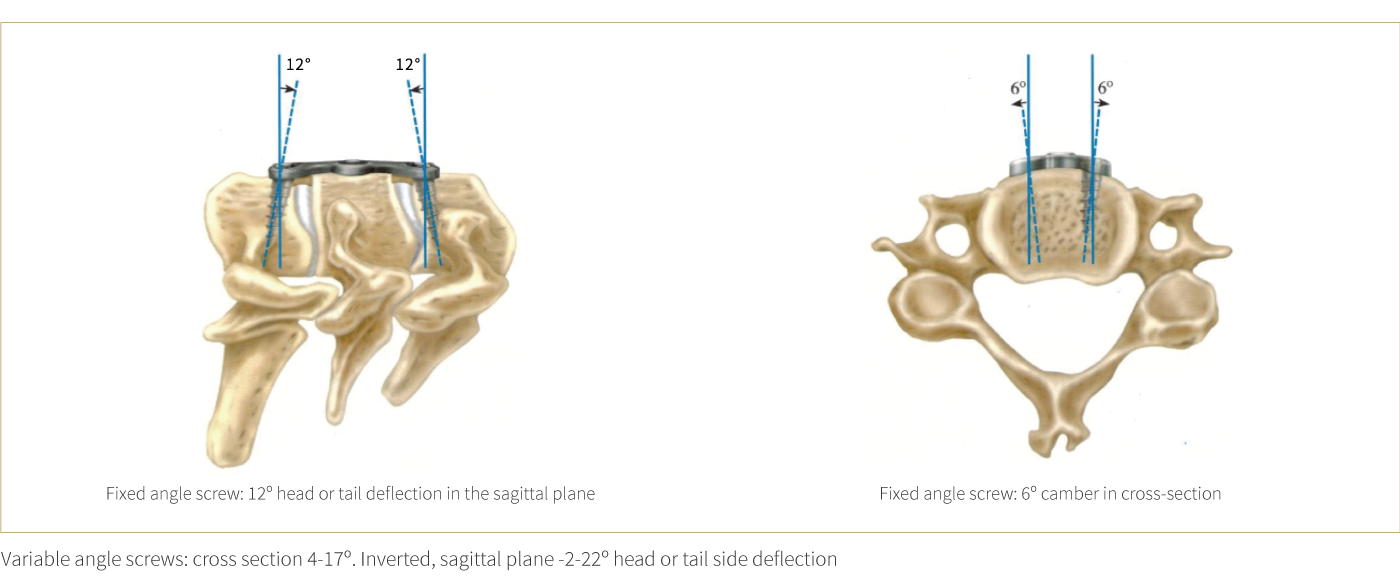 Anterior Cervical Plate - Type II