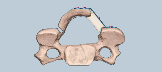 U-shaped Titanium Plate