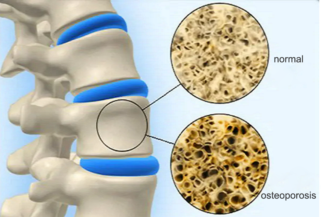 Normal Bone vs. Osteoporosis