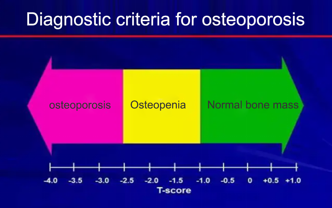 Diagnostic criteria for osteoporosis