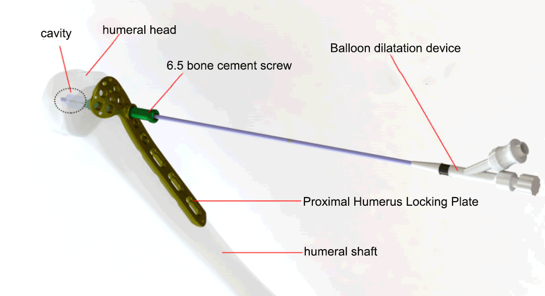 Balloon Cement-Augmented Locking Plate System