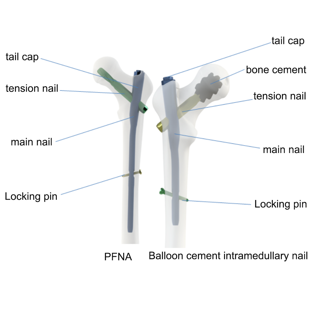 Traditional PFNA Fixation and  Balloon Bone Cement Intramedullary Nail