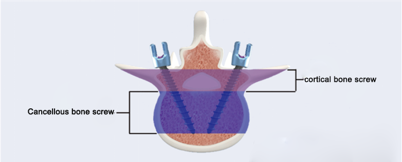 Decompression Fusion System