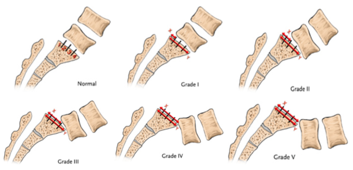 Meyerding classification Meyerding classification