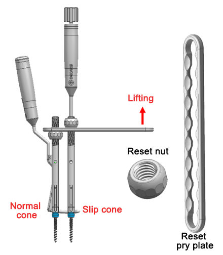  Reduction via Sliding Reduction Plate