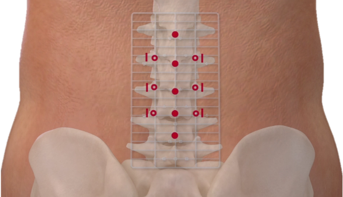 .Fluoroscopic localization to confirm the surgical level