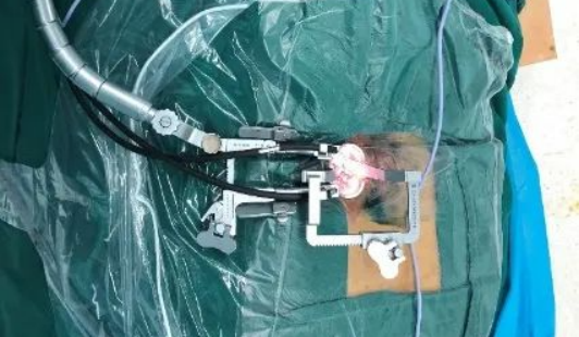 Establish minimally invasive access