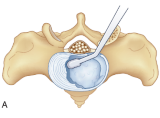 Prepare the intervertebral disc space