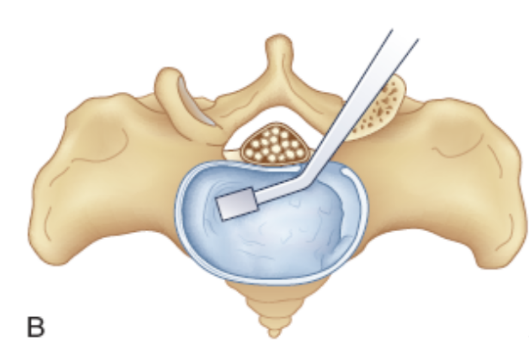 Prepare the intervertebral disc space
