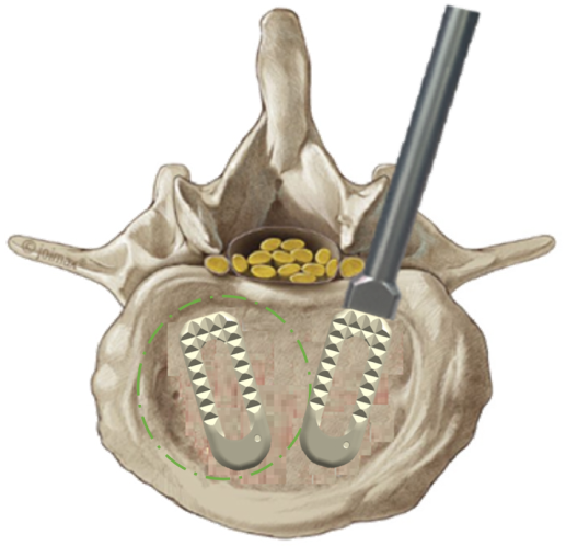Insert interbody cage 