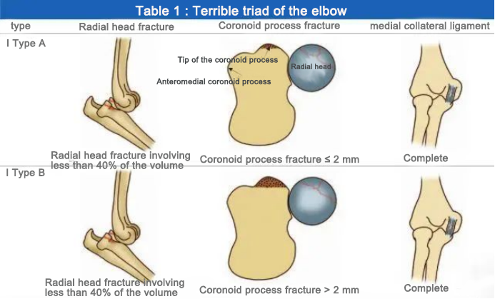 Terrible triad of the elbow