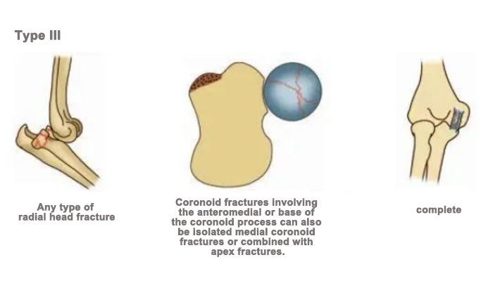 anteromedial coronoid fracture, consistent with the anteromedial facet fracture