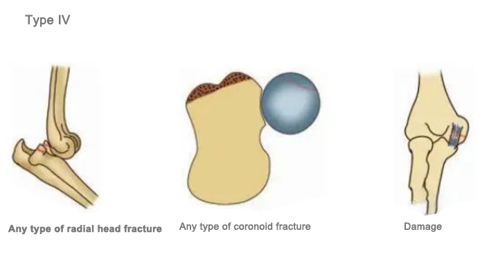  radial head fracture, coronoid fracture