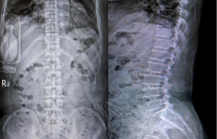 Postoperative imaging
