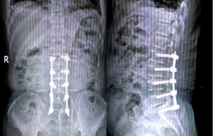 Postoperative 6-month Imaging