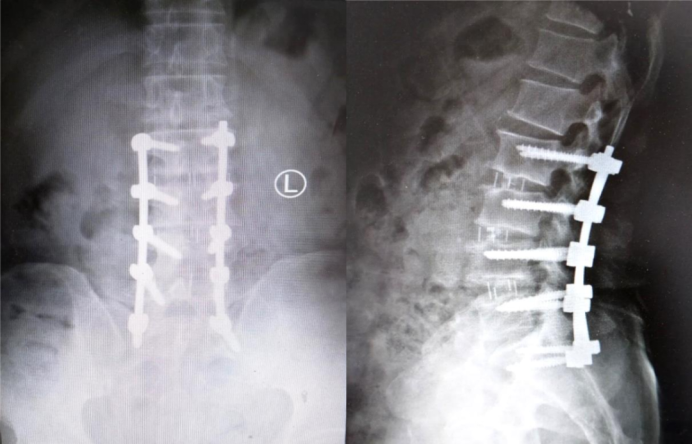 Postoperative 6-month Imaging
