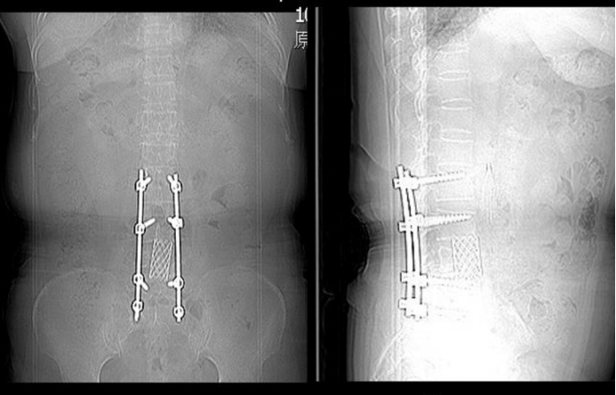 6-month postoperative imaging
