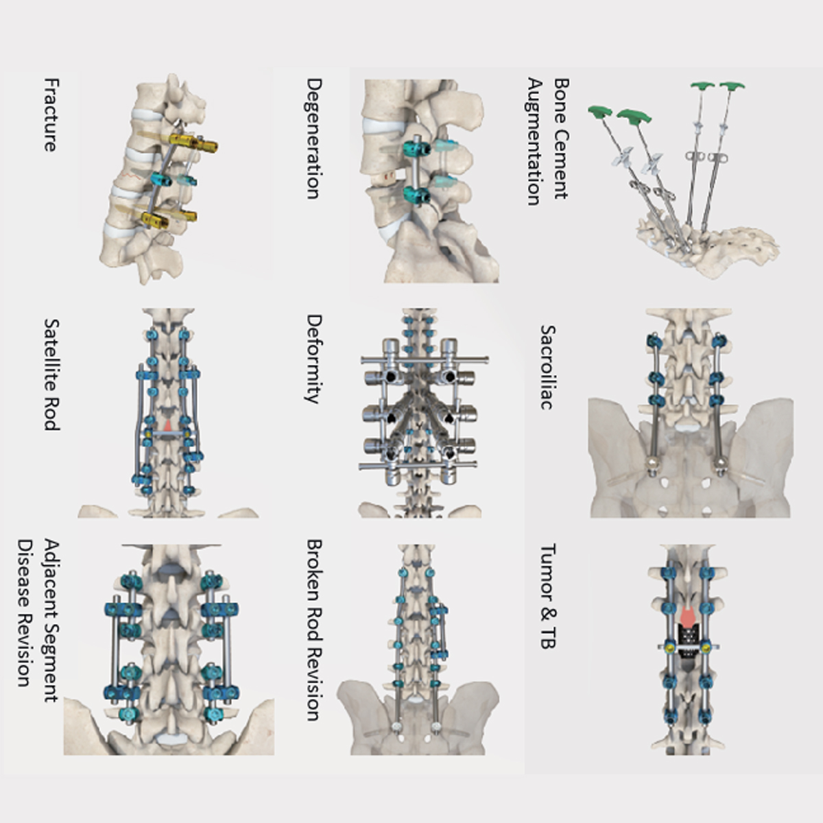Luna Posterior Thoracolumbar Spinal System